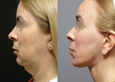 Facial Fat Transfer before and after photos by Sherber and Rad in Washington, DC