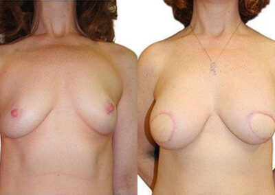 Love Handle Flap before and after photos by Sherber and Rad in Washington, DC