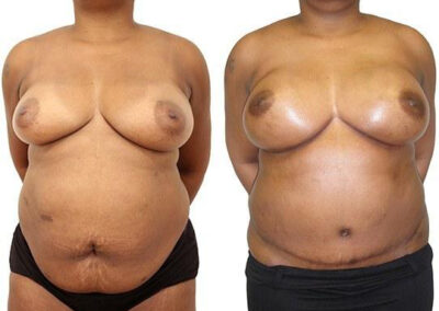 DIEP Flap before and after photos by Sherber and Rad in Washington, DC