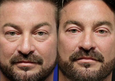 Facial Fat Transfer before and after photos by Sherber and Rad in Washington, DC