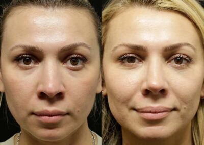 Facial Fat Transfer before and after photos by Sherber and Rad in Washington, DC