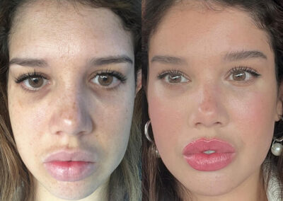 Facelift before and after photos by Sherber and Rad in Washington, DC