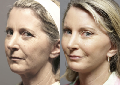 Facelift before and after photos by Sherber and Rad in Washington, DC