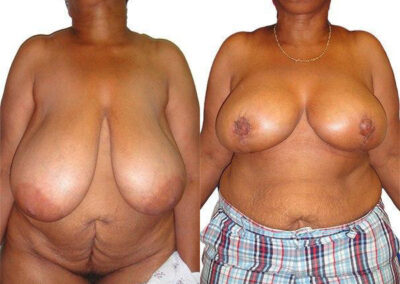 Breast Lift + Reduction before and after photos by Sherber and Rad in Washington, DC