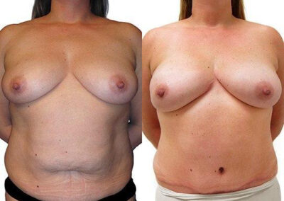 DIEP Flap before and after photos by Sherber and Rad in Washington, DC