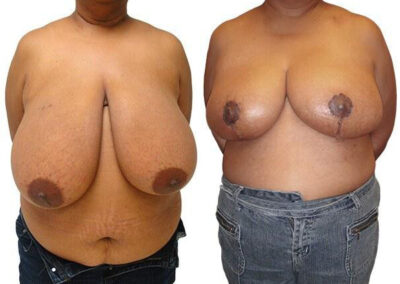 Breast Lift + Reduction before and after photos by Sherber and Rad in Washington, DC