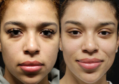 Female Eyelid Lift before and after photos by Sherber and Rad in Washington, DC