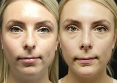 Chin + Jaw Reshaping before and after photos by Sherber and Rad in Washington, DC