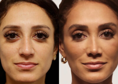 Facelift before and after photos by Sherber and Rad in Washington, DC