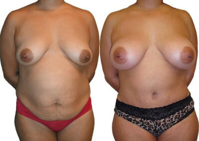 Breast Augmentation before and after photos by Sherber and Rad in Washington, DC