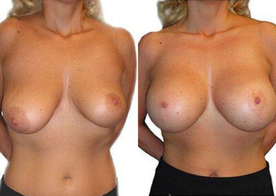 Breast Augmentation before and after photos by Sherber and Rad in Washington, DC