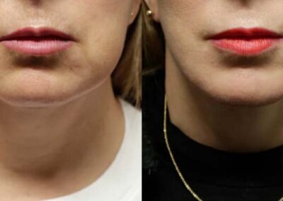 Facelift before and after photos by Sherber and Rad in Washington, DC