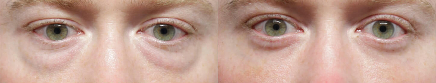 Female Eyelid Lift before and after photos by Sherber and Rad in Washington, DC