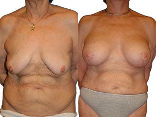 Breast Lift + Reduction before and after photos by Sherber and Rad in Washington, DC
