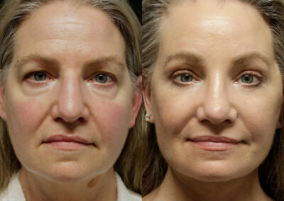 Facelift before and after photos by Sherber and Rad in Washington, DC