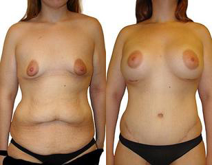 Massive Weight Loss before and after photos by Sherber and Rad in Washington, DC