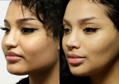 Chin + Jaw Reshaping before and after photos by Sherber and Rad in Washington, DC