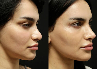 Facelift before and after photos by Sherber and Rad in Washington, DC