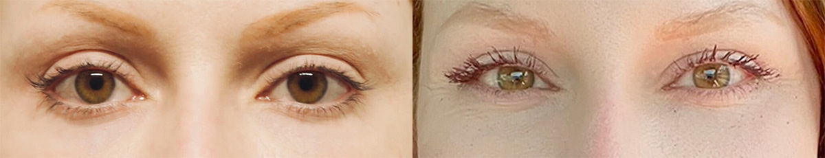 Female Eyelid Lift before and after photos by Sherber and Rad in Washington, DC