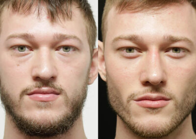 Brow + Forehead Lift before and after photos by Sherber and Rad in Washington, DC