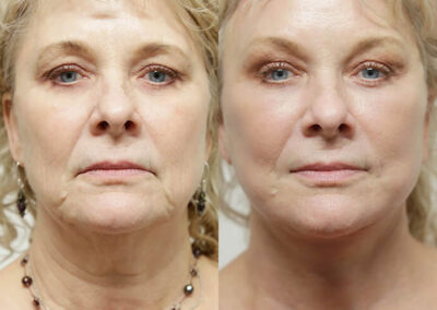 Facelift before and after photos by Sherber and Rad in Washington, DC