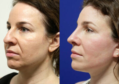 Facelift before and after photos by Sherber and Rad in Washington, DC