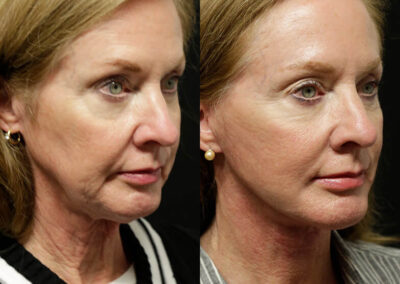 Facelift before and after photos by Sherber and Rad in Washington, DC