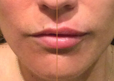 Liquid Facelift before and after photos by Sherber and Rad in Washington, DC