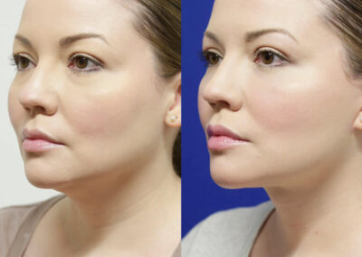 Facelift before and after photos by Sherber and Rad in Washington, DC