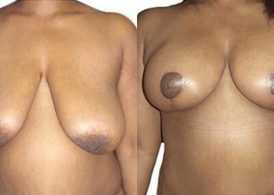 Massive Weight Loss before and after photos by Sherber and Rad in Washington, DC