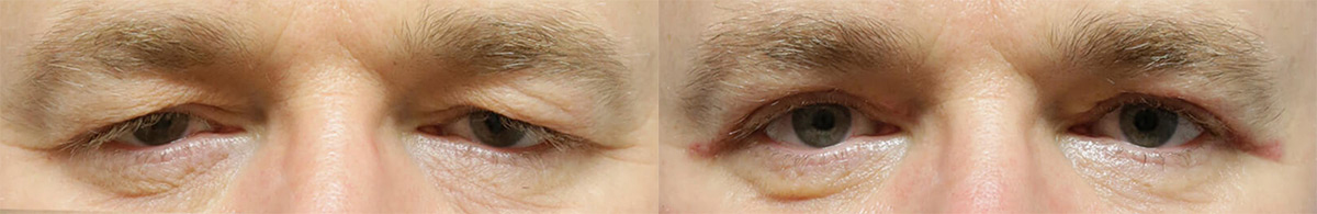 Male Eyelid Lift before and after photos by Sherber and Rad in Washington, DC