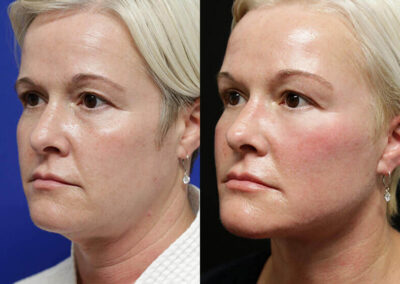 Facelift before and after photos by Sherber and Rad in Washington, DC