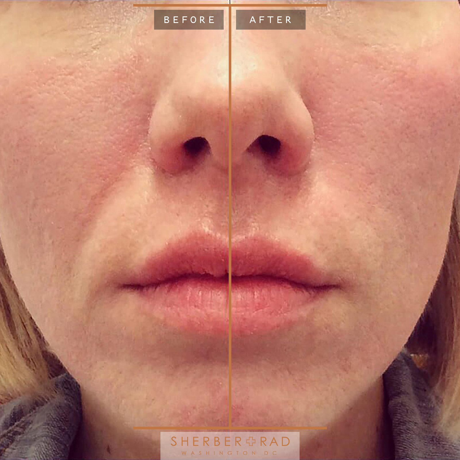 lip filler washington d.c. Lip Filler Trends in Washington, DC: What's Hot in 2024