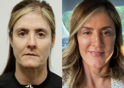 Facelift before and after photos by Sherber and Rad in Washington, DC