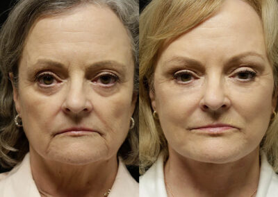 Facelift before and after photos by Sherber and Rad in Washington, DC