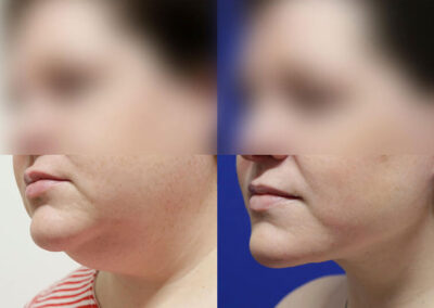 Facelift before and after photos by Sherber and Rad in Washington, DC