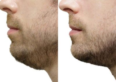 Neck Lift before and after photos by Sherber and Rad in Washington, DC