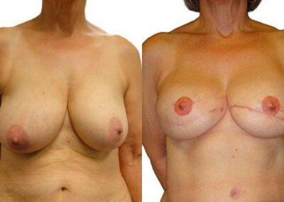 DIEP Flap before and after photos by Sherber and Rad in Washington, DC