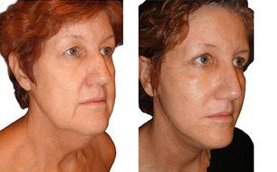 Neck Lift before and after photos by Sherber and Rad in Washington, DC