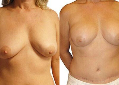 DIEP Flap before and after photos by Sherber and Rad in Washington, DC