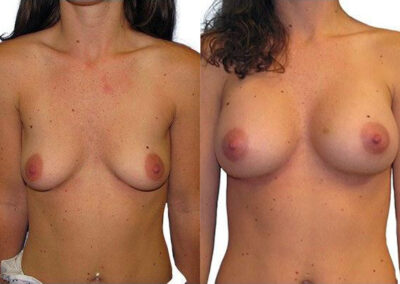 Breast Augmentation before and after photos by Sherber and Rad in Washington, DC