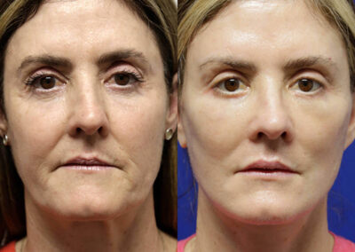 Facelift before and after photos by Sherber and Rad in Washington, DC