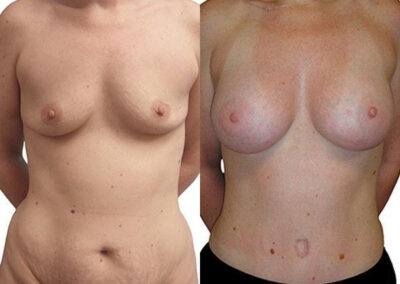 Breast Augmentation before and after photos by Sherber and Rad in Washington, DC
