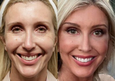 Neck Lift before and after photos by Sherber and Rad in Washington, DC