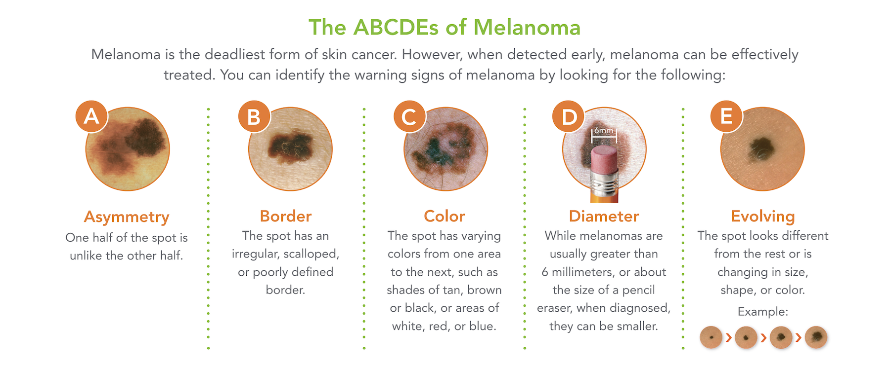 ACDEs of Melanoma ACDEs of Melanoma