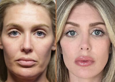 Deep Plane Facelift before and after photos by Sherber and Rad in Washington