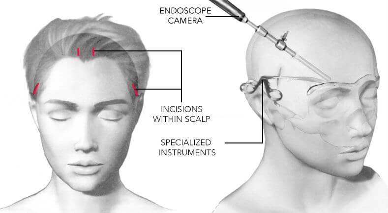 browlift endo illustration