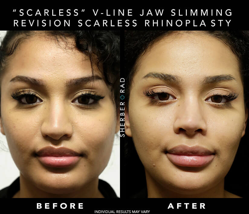 Chin Augmentation before and after photos by Sherber and Rad in Washington, DC