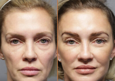 deep plane facelift before and after photos by sherber and rad in washington dc