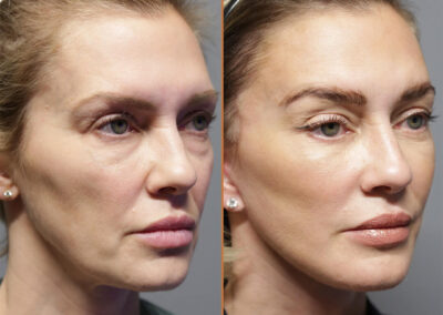 deep plane facelift before and after photos by sherber and rad in washington dc